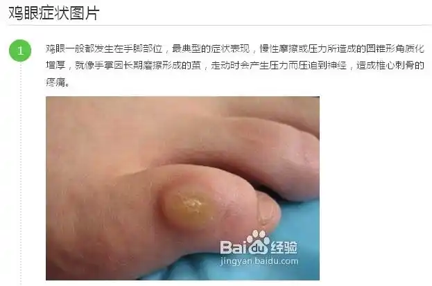 鸡眼的形成和去除!