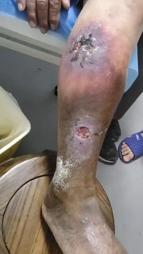 小腿老烂腿,伤口大,长时间不能愈合,伤口流水流脓,发黑疼痛,发痒!