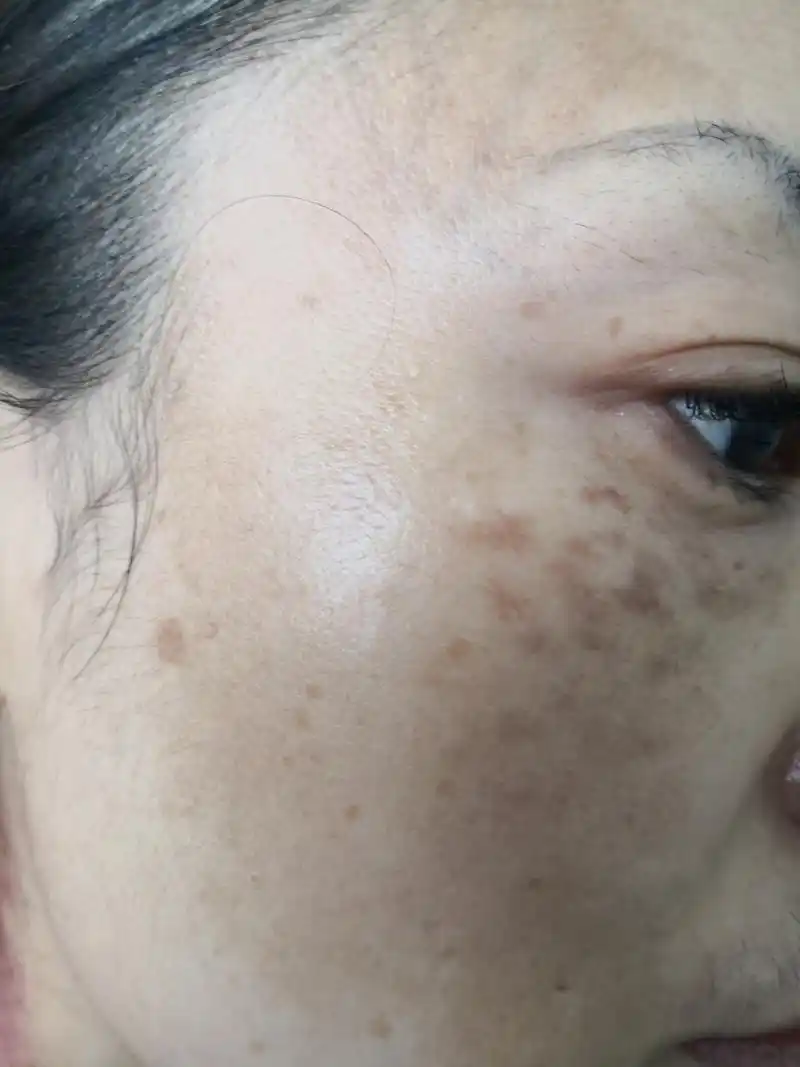 坚持治疗非常重要#美容