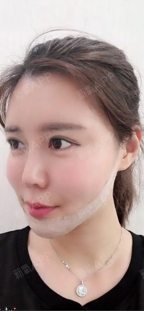 自体脂肪填充全脸