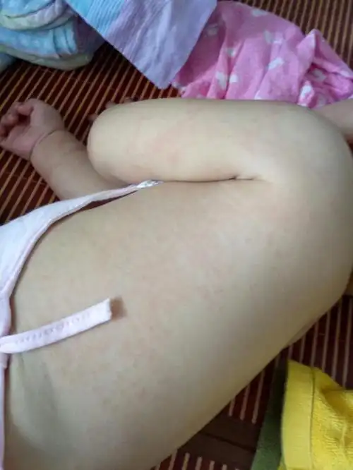 宝宝过敏,全身都是红点点,是吃酸奶