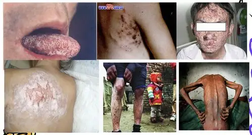 "预防艾滋病,共建美好校园" ——— 龙源坝初级中学健康教育讲座