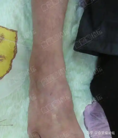 为什么有些类型的血管瘤会疼痛