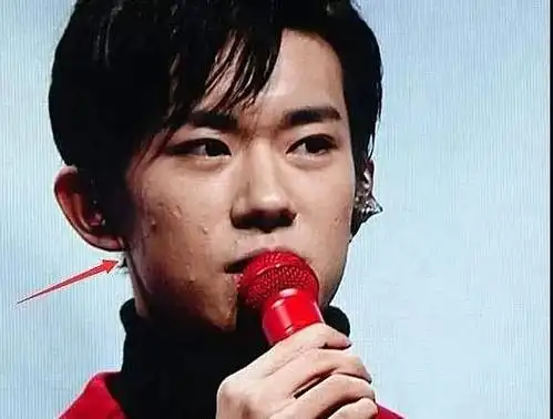 tfboys生图:王俊凯青春痘,王源痘痘肌,而易烊千玺让人更失望