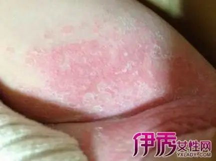 【图】宝宝大腿内侧湿疹怎么办? 7个妙招较你预防儿童湿疹