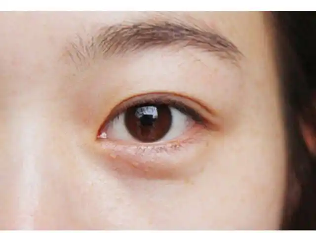 左眼下眼睑跳动是什么原因眼皮跳动的原因是什么
