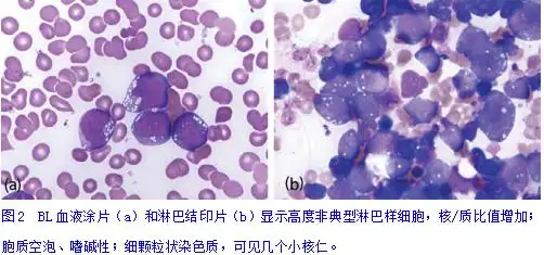 伯基特淋巴瘤的病理诊断和鉴别诊断(一)