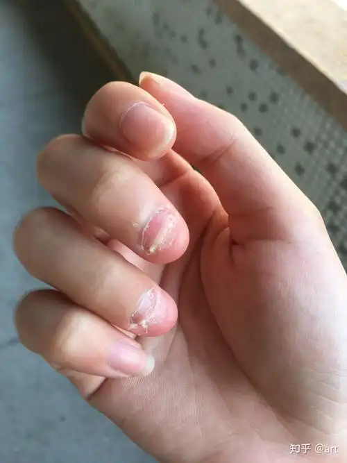 一个人喜欢不自觉的啃手指甲反映了什么潜在的生理心理特征