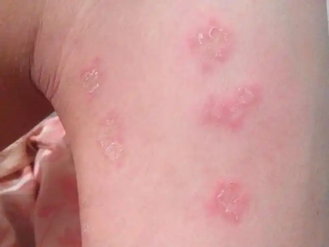 展开全部 看图需要考虑癣菌疹.