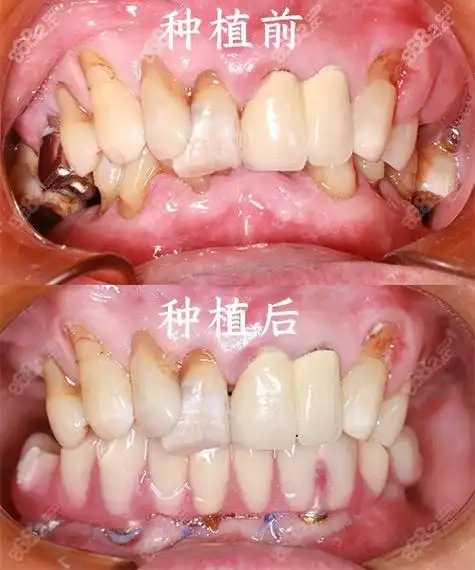 种植牙有后遗症出现这些状况要知道怎么处理