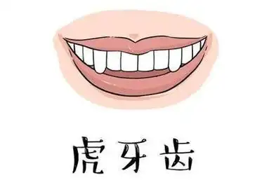牙齿矫正    【导语】虎牙也就是俗称的犬齿,即上颌的两颗单尖牙,它