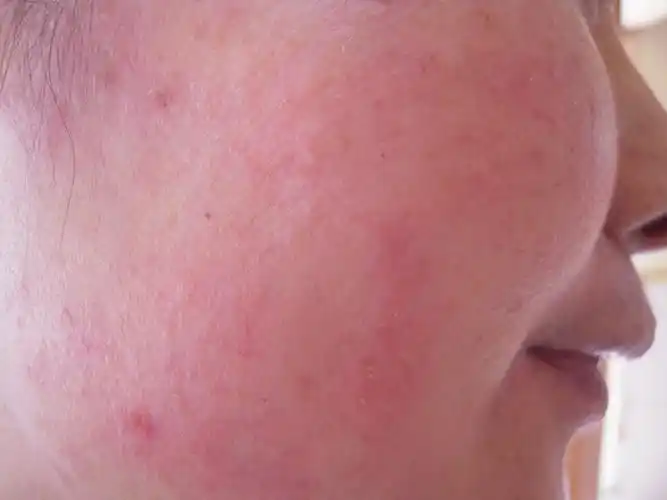 过敏性皮炎日常护理须知