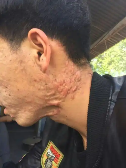 面部痤疮(粉刺,青春痘)治疗同位素敷贴最有效(山东青岛) - 好大夫在线