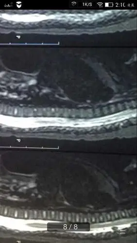 跪求助宝宝四个月脊髓中央管轻度扩张意味着什么