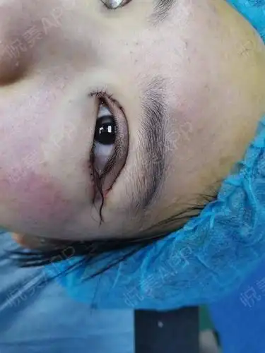 开眼角手术眼角有内眼角和外眼角之分有双眼皮吗 - 一流范文网
