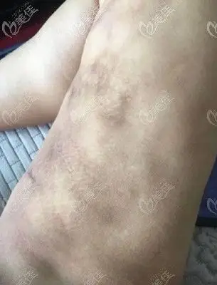 求问大腿吸脂皮肤肌肉粘连症状是什么怎么消除