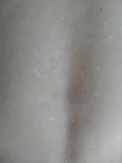 特发性滴状色素减少症   四肢,面部以及躯干部出现的中央凹陷的点状