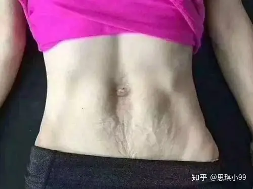 其次的明显变化就是皮肤松弛下垂了,因为在孕期,胎儿的成长会使得子宫