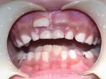 孩子恒牙长出乳牙未掉需要拔吗出现双排牙怎么办