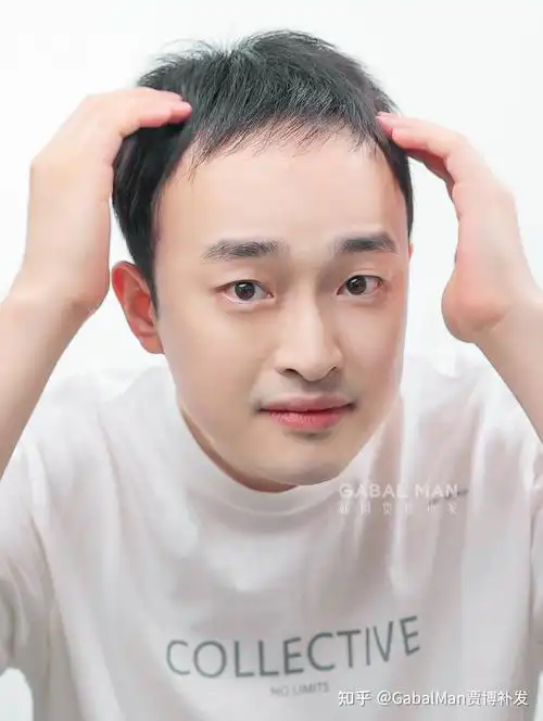发友分享原来秃头男士也能拥有帅气发型这改变真绝