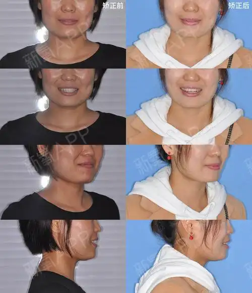 这个女生上颌有两颗虎牙,沟通中她非常恐惧拔牙,经过_圈子-新氧美容