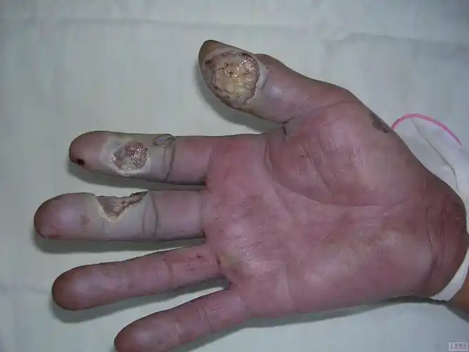 讨论电烧伤右手7天