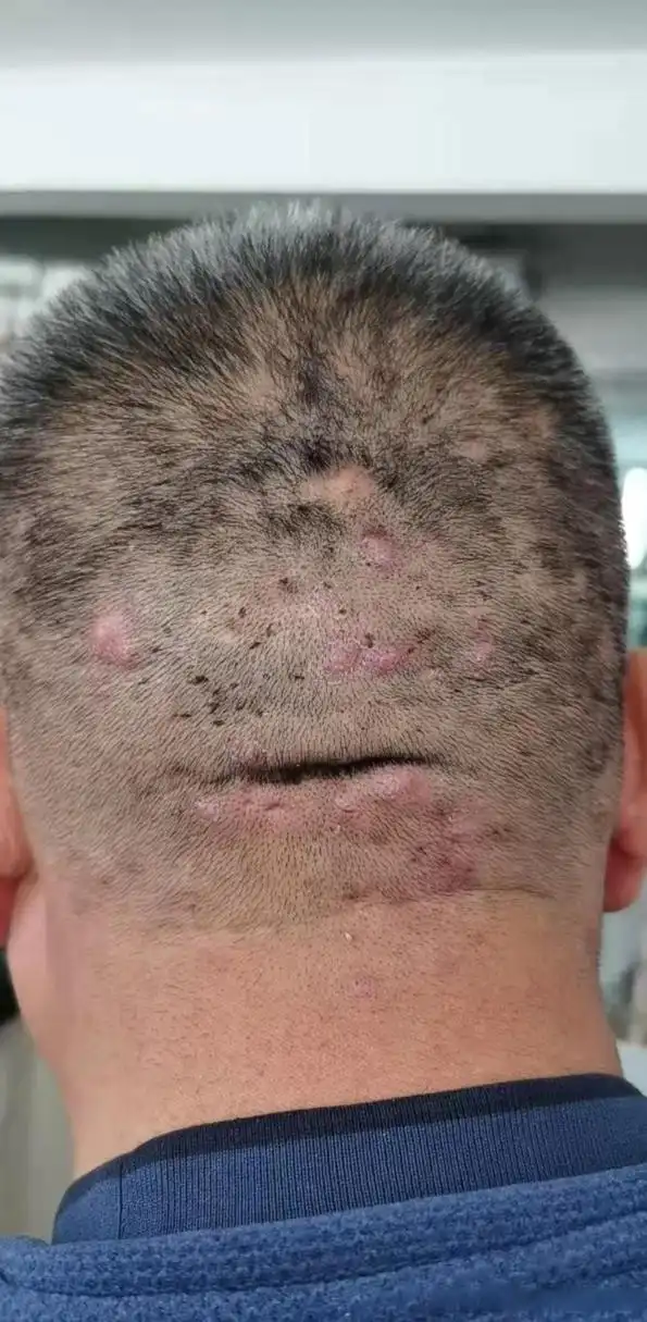 今天有个46岁的男患者来复诊,他得了毛囊炎已经7年了.