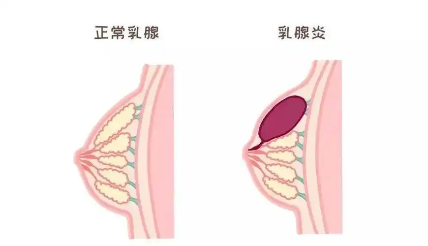 哺乳期乳头疼痛还能继续喂奶吗