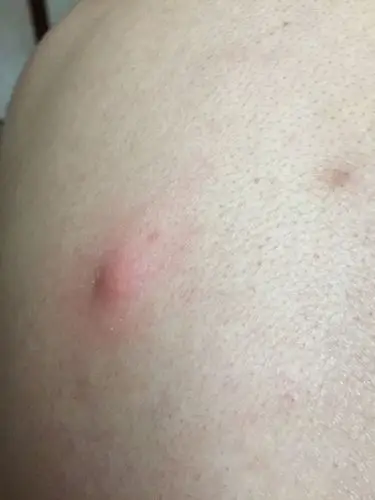 怀孕14周了,后背起了个这个,一碰就疼,是火疖子吗?