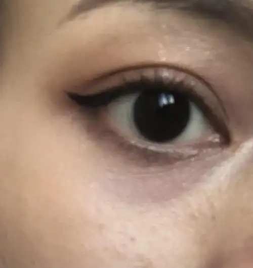 这种黑眼圈是发青吗