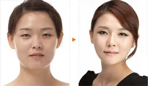 上睑下垂矫正有哪些方法 - 上海华美医疗美容医院【官网】