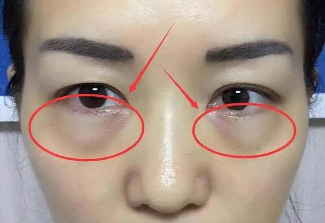 眼袋形成有这三大原因,你中招了吗?