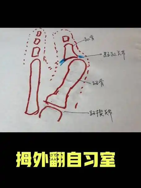 拇外翻chevron截骨术