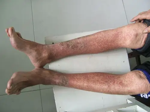 【病例讨论】这个老人小腿是湿疹吗 [病例帖]