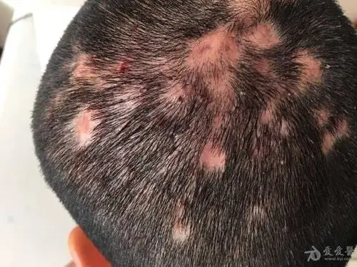 看图诊断秃发性毛囊炎