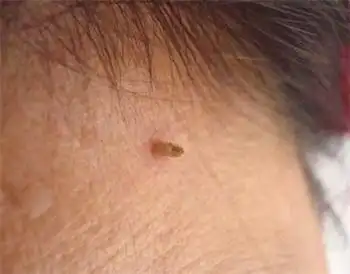 颈部长丝状疣在江门还是去广州的医院治疗比较好?