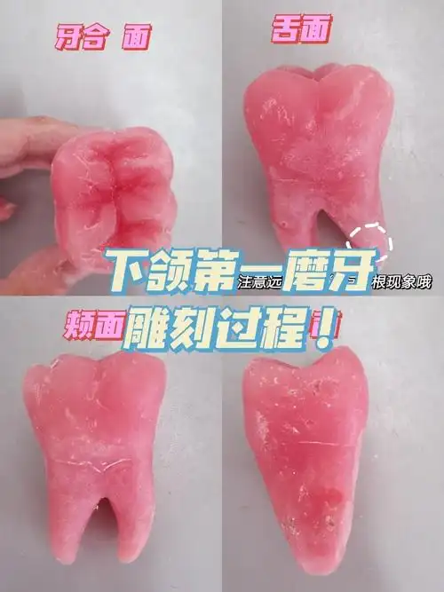 下颌第一磨牙雕刻全过程!步骤:1.先画近中面(再雕)2.