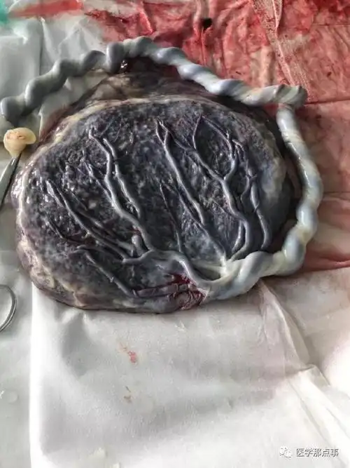 这些异常的胎盘,你见过么?