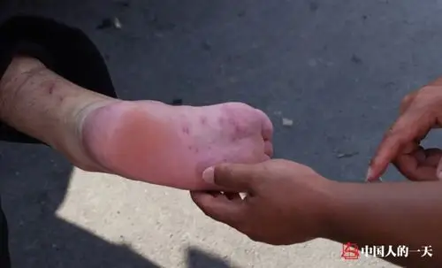 一名队员脚底板溃烂,被队长李延照要求休整治疗,"恢复最好的状态才能