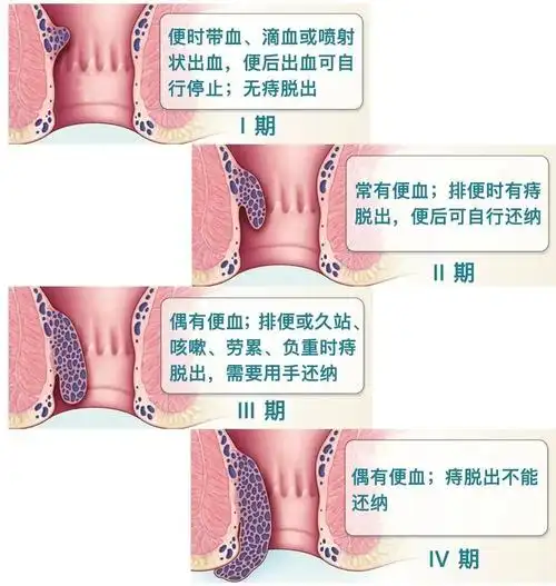 小博医生:终于等到你!微创痔疮内镜手术,让痛苦远离!-健康案例-北京市