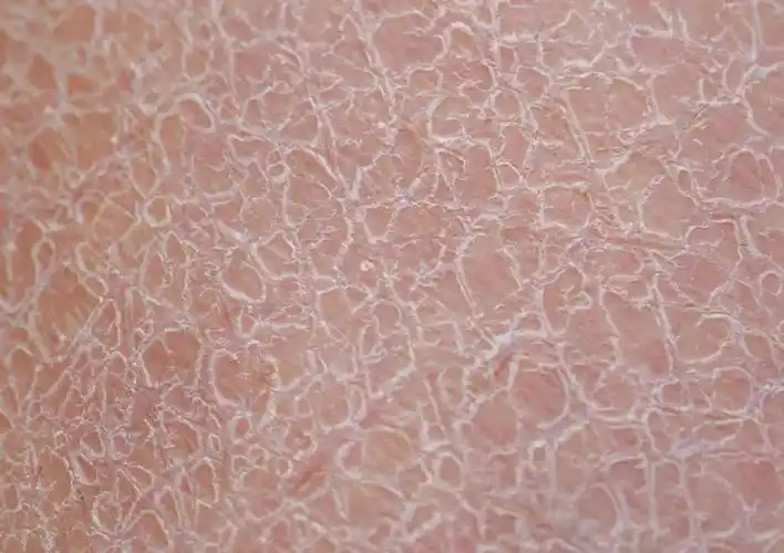 世上近一半的人,都有天生的皮肤缺陷_角质