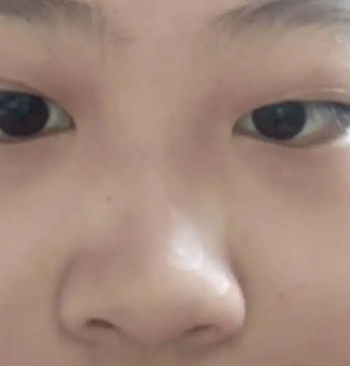 没有鼻梁,鼻子塌的人是什么体验?