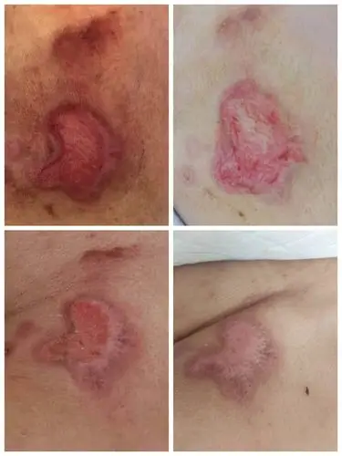 开展压疮护理会诊,提高专科护理质量