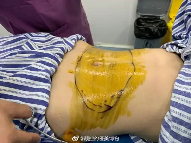 厦门腰腹环吸##福建厦门负压/酷塑/威塑/水动力吸脂抽脂手术