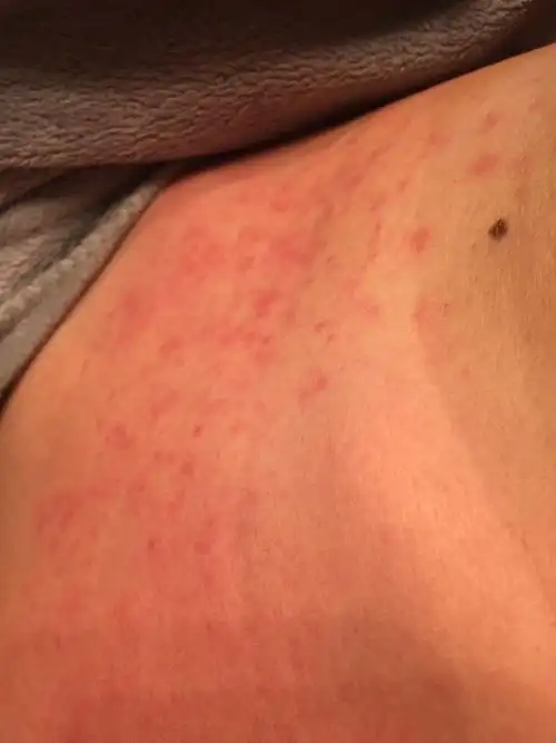 很痒,已经两天了,吃了抗过敏的药也还没好,以前我吃虾也不过敏