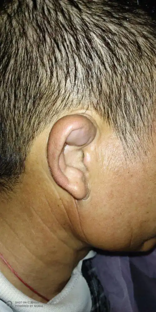 耳朵长了这个东西,是什么呢?