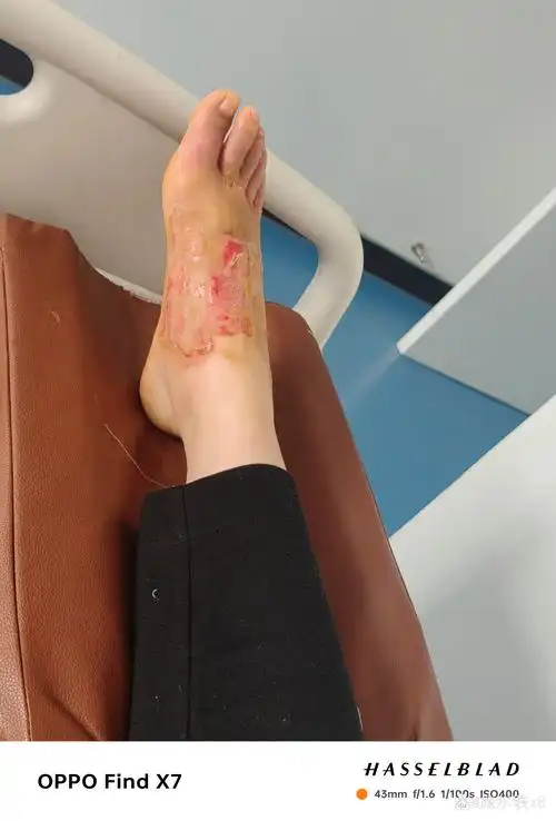 脚烫伤浅2度恢复图 图一是烫伤第4天 脚还没反应过来 住院休了9天