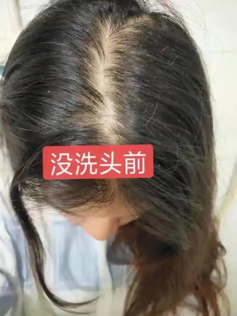 9999螨虫91  对头皮的危害,不可忽视05蜜植素强效去屑 - 抖音