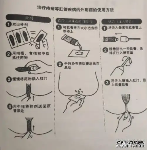 得痔疮用什么药效果好?