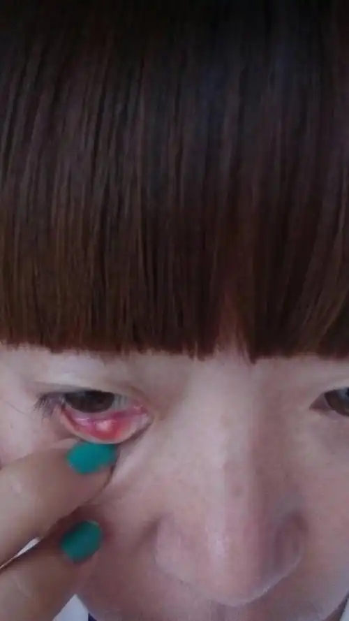 眼睛长一个圆疙瘩,几乎没有什么疼痛,就是低头的时候会充血,涨的慌.